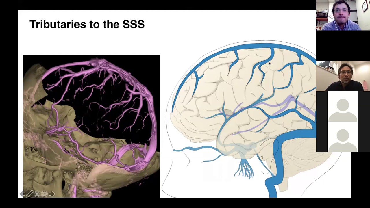 2020 04 21 BANANAZ Venous Sinuses