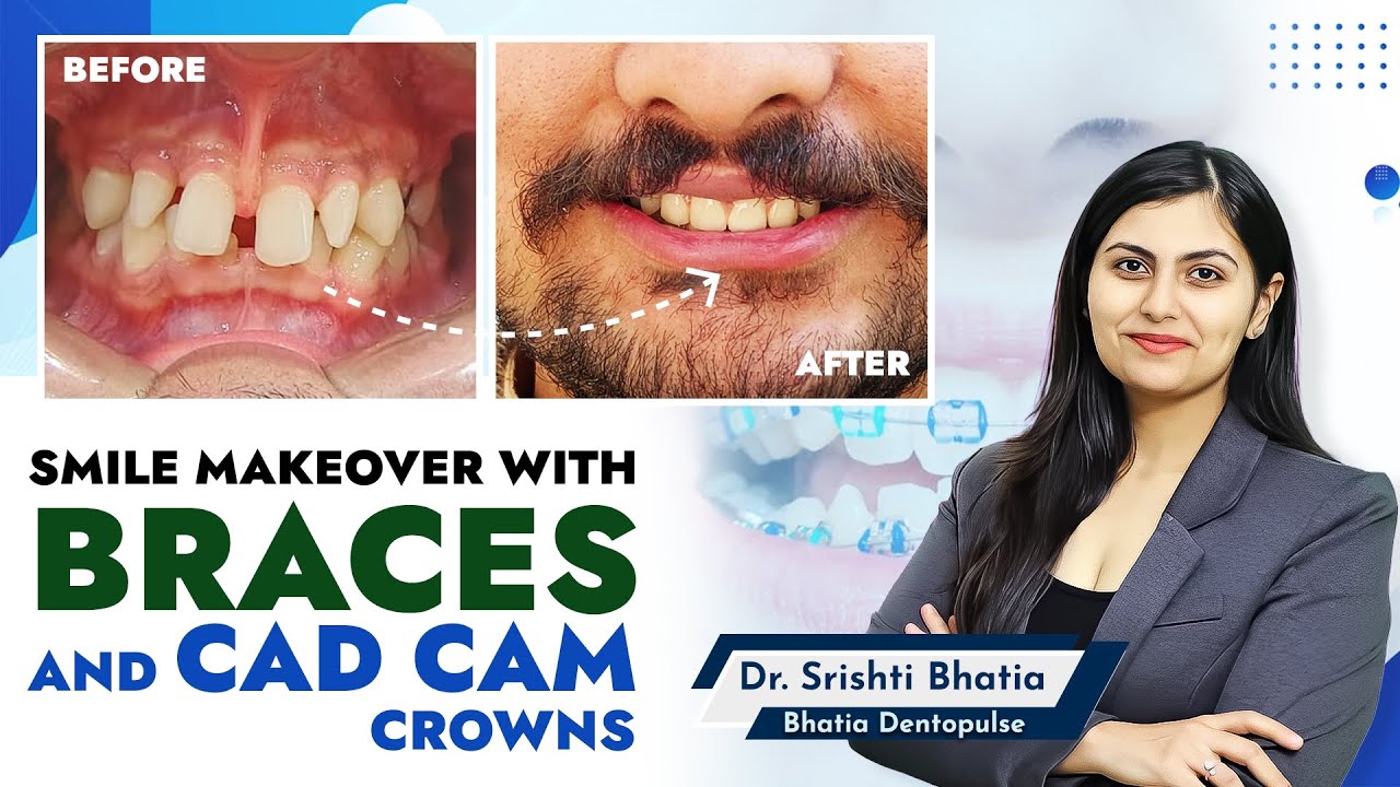 Smile Makeover with BRACES and CAD CAM crowns: Dr. Srishti Bhatia #smile #smilemakeover