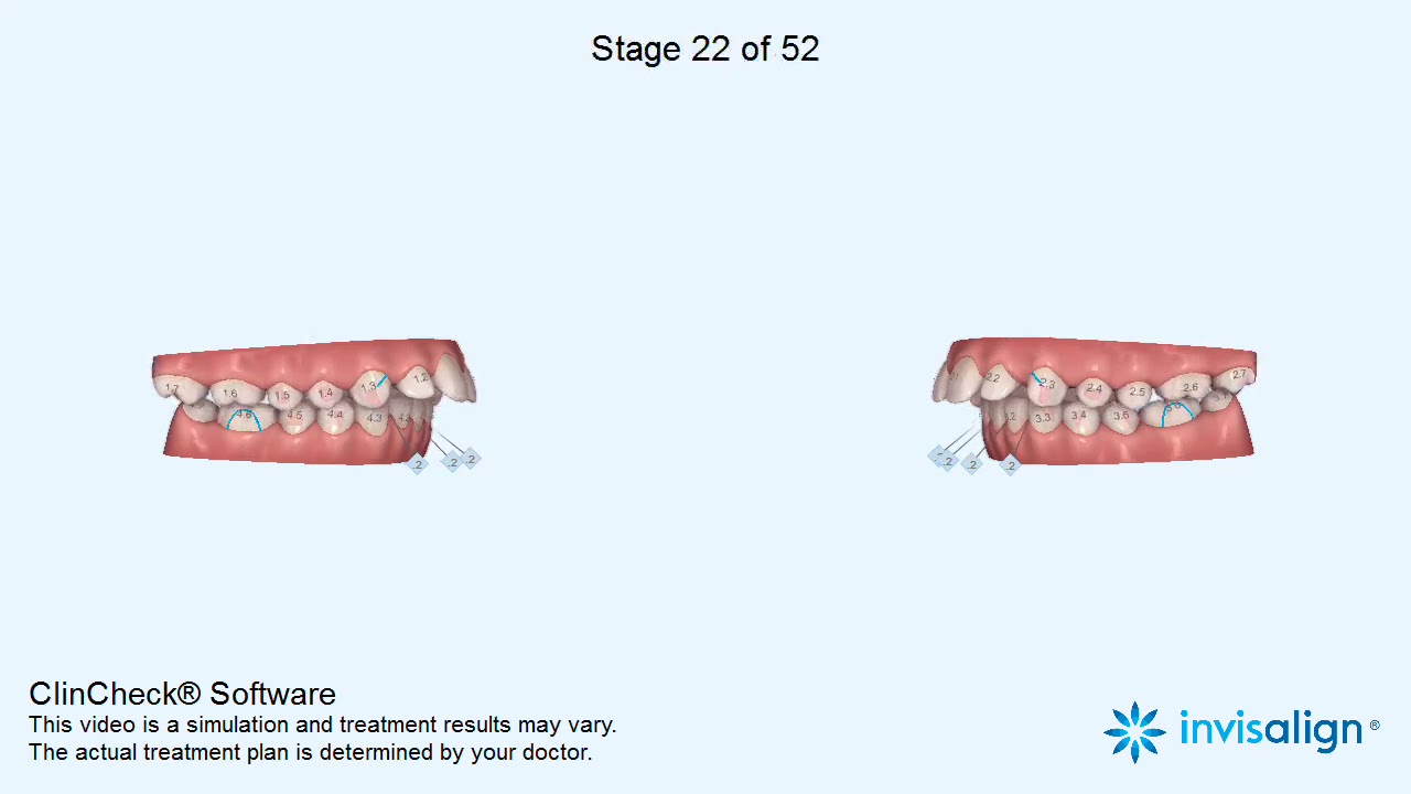 Increased overjet correction by Invisalign by Sphinx Orthodontics