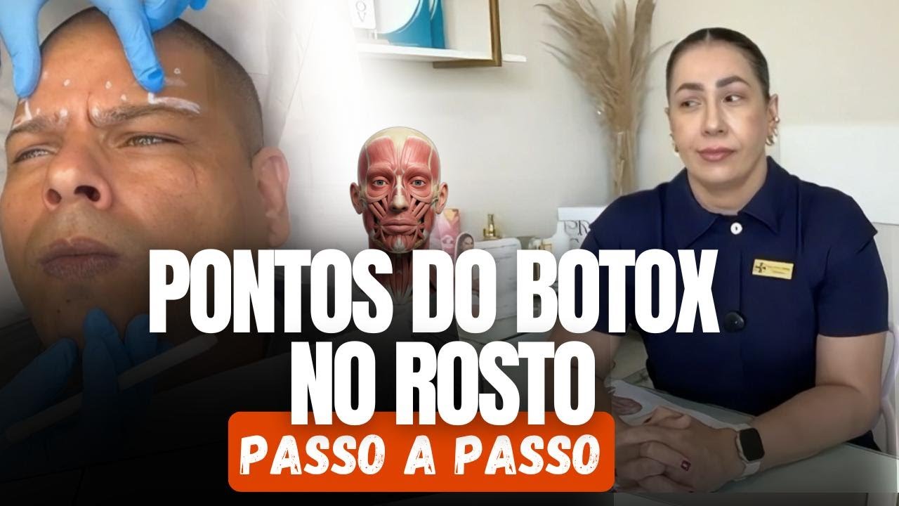 MARCAÇÃO DOS PONTOS PARA APLICAÇÃO DO BOTOX FACIAL PASSO A PASSO!