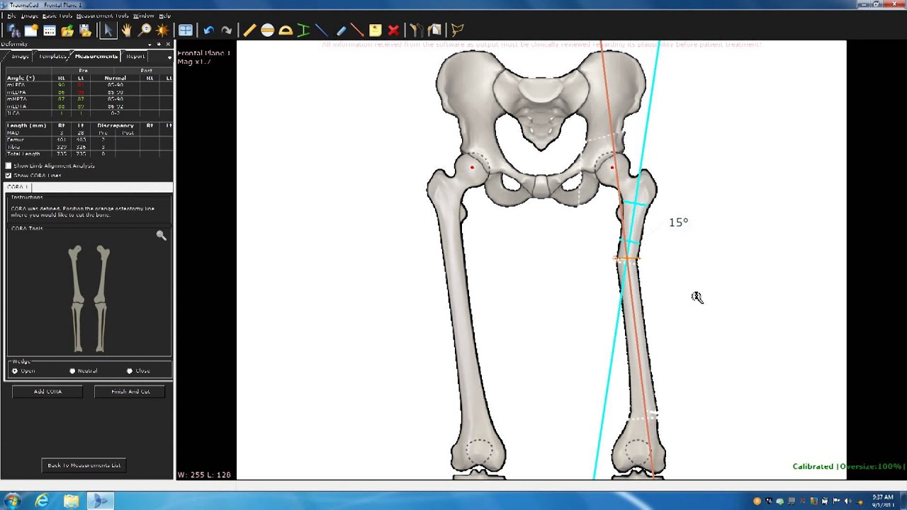 TraumaCad Deformity Course Part 2A - Deformity Correction