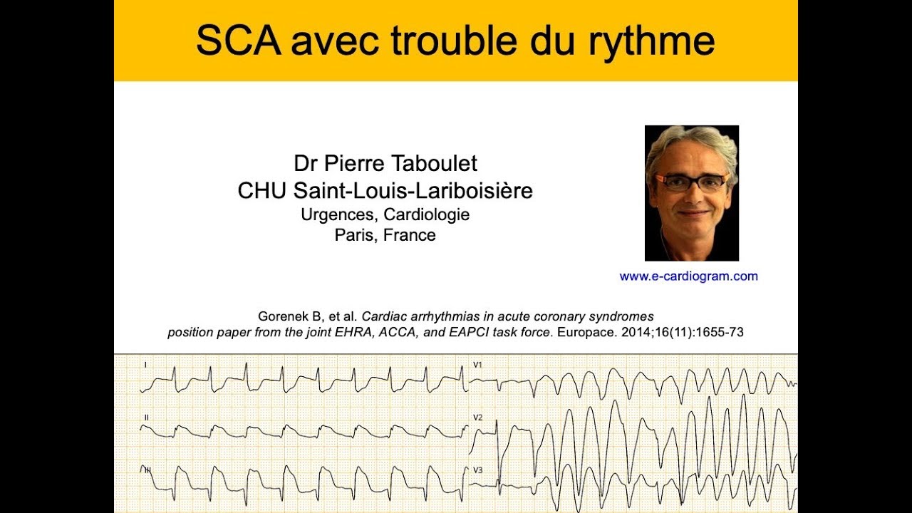 Infarctus et trouble du rythme. ECG. Dr Taboulet