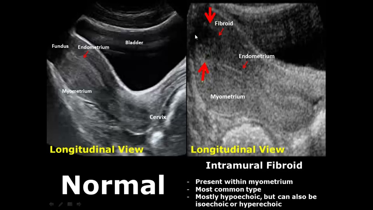 Uterus Ultrasound Normal Vs Abnormal Image Appearances Comparison | Uterine Pathologies USG