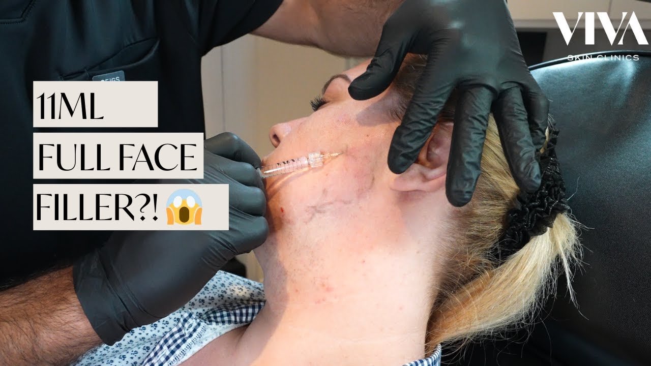 10ml Full Face Filler After Weight Loss 😱 Shocking Dermal Filler Results