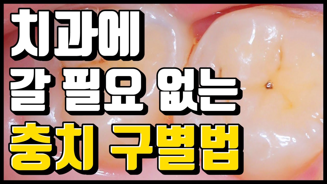 충치 자연치유? 치과 진료가 필요 없는 충치 구별법! (feat.과잉 진료 방지법)