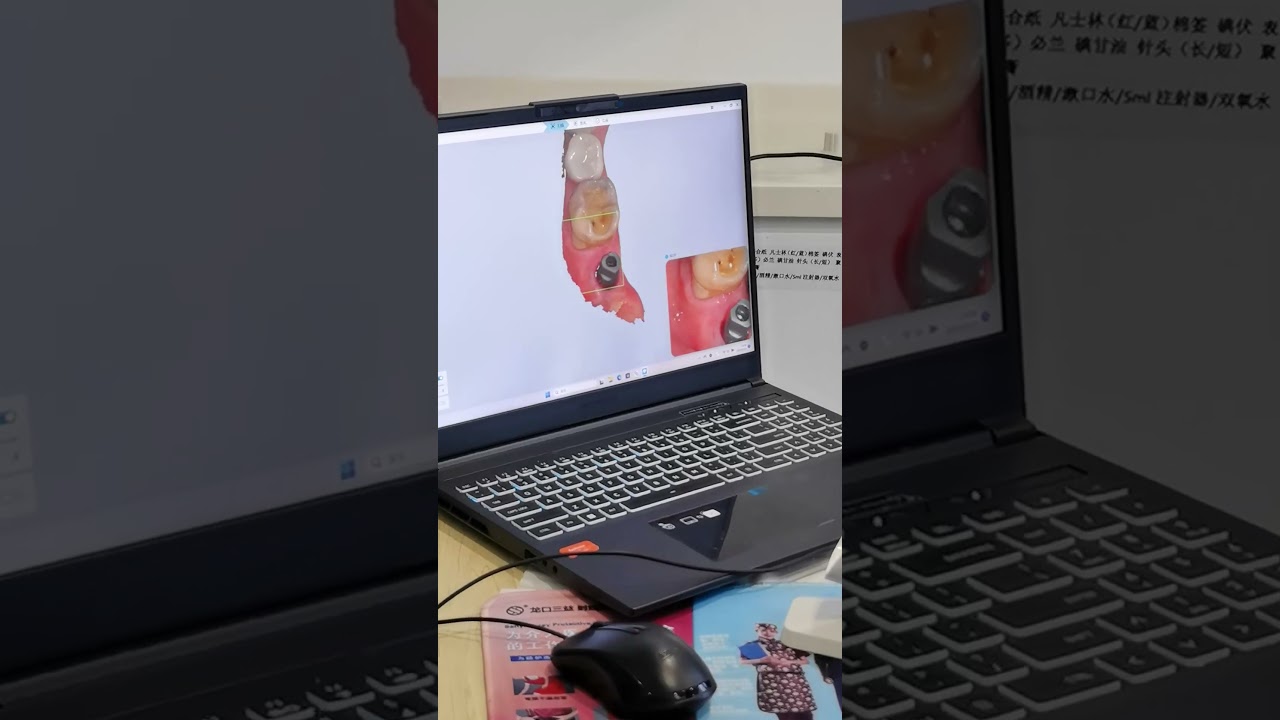When Implants Meet Oral Scanners. #youtube