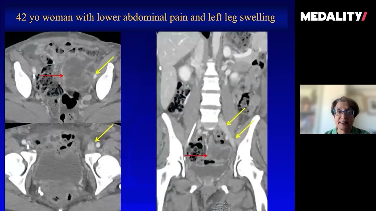 Free Vascular Ultrasound Case | Dampened Flow in Left External Iliac Vein | Dr. Sheila Sheth