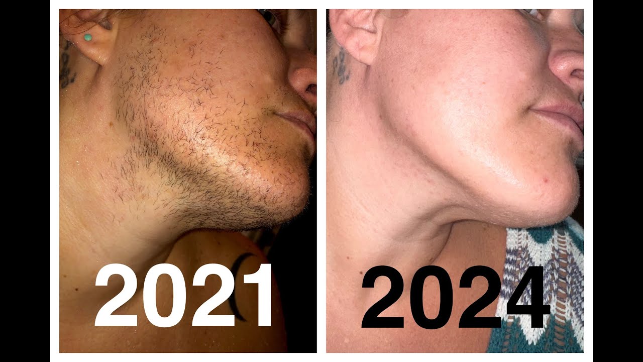 Results after 161 Hours of Electrolysis facial hair removal: PCOS, Hirsutism, Excess Hair