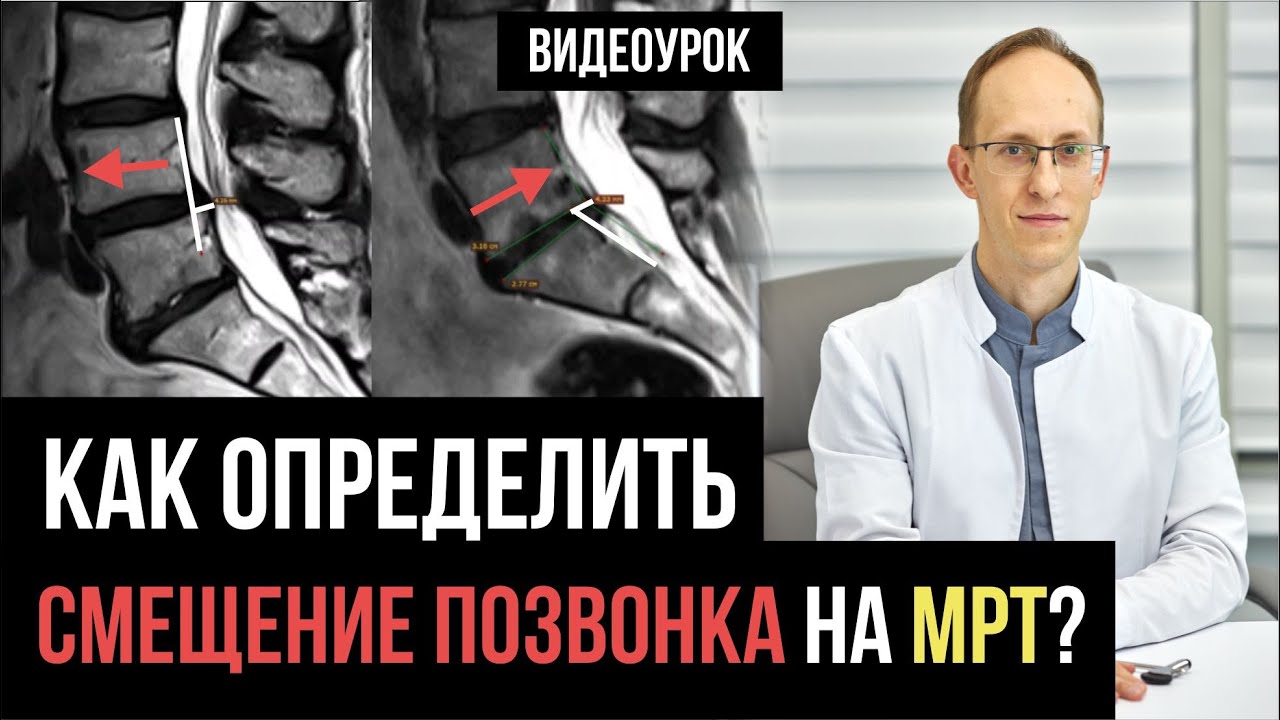 Антелистез и ретролистез поясничном отделе