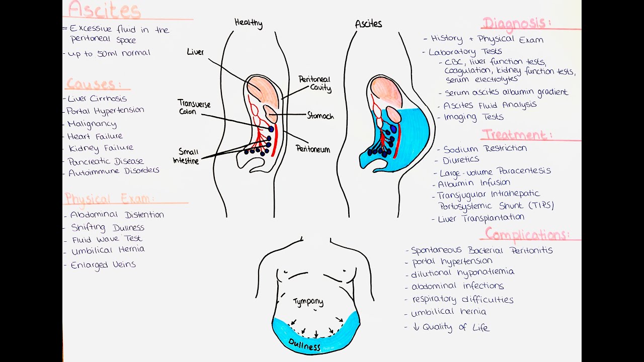 Ascites - Causes, Diagnostic Algorithm, Treatment, Complications