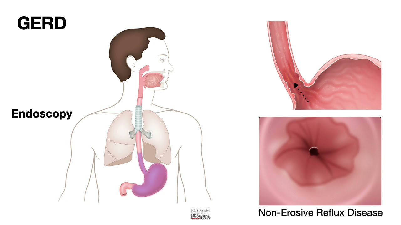 HCC 1475-2b-Pathology of Esophagus - Erosive Esophagitis
