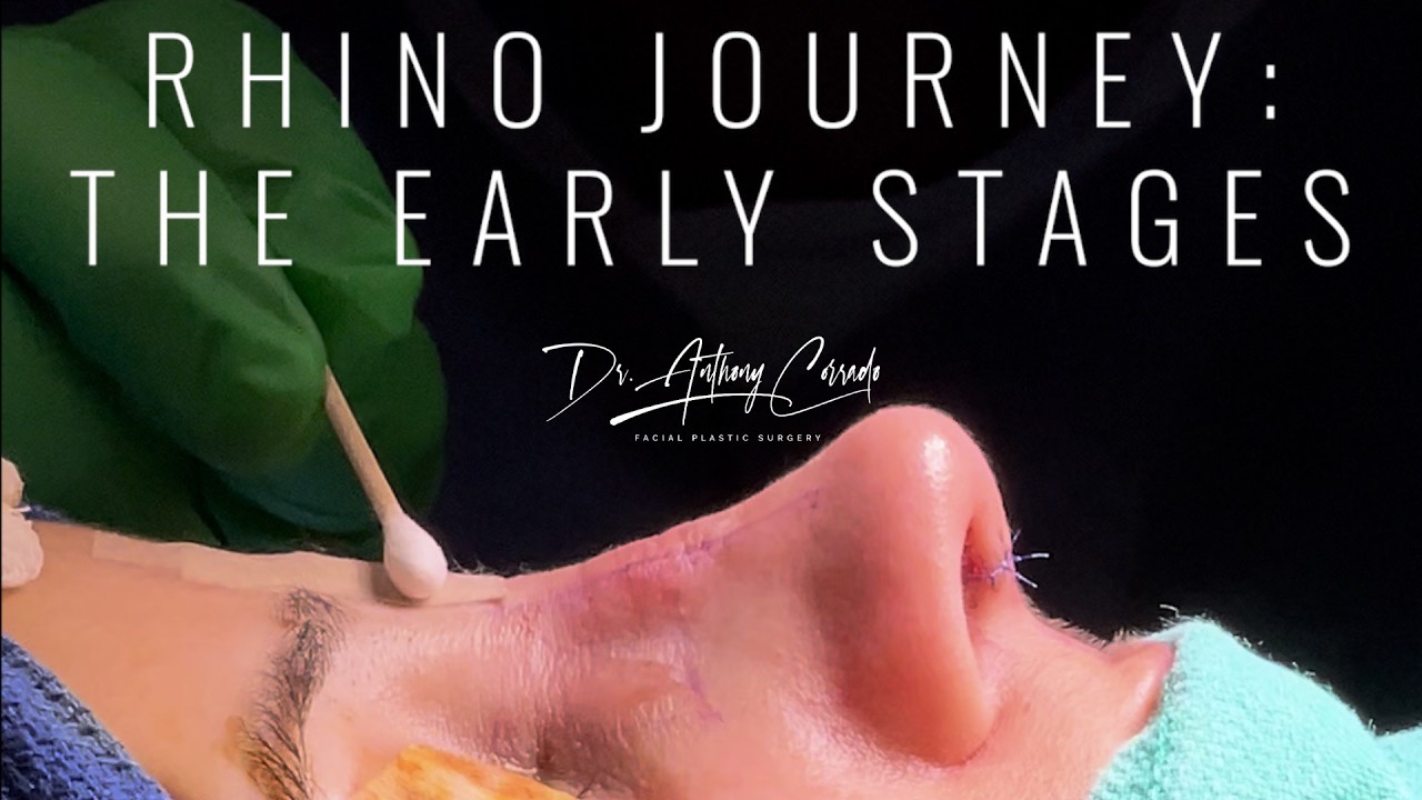 Dorsal Hump Rhinoplasty Journey (Part 1) | Stunning 1‑Week Rhinoplasty Reveal with Dr. Corrado