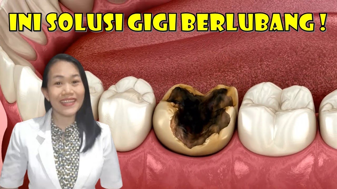 Bukan ditambal! Bukan dicabut! Ini solusi gigi berlubang!