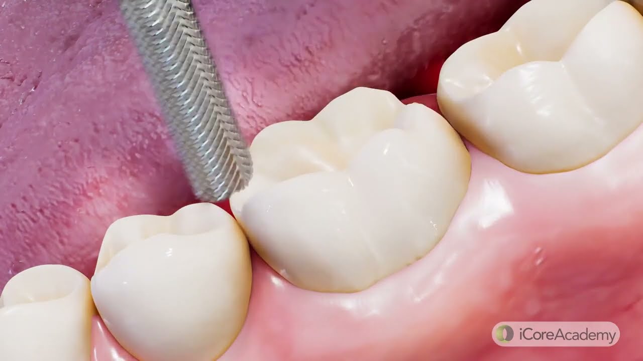 Mastering Crown Post-Op Care | Your Essential Guide to a Healthy Recovery