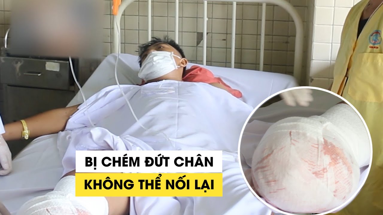 Thiếu niên Tây Ninh bị chém đứt lìa chân không thể nối lại