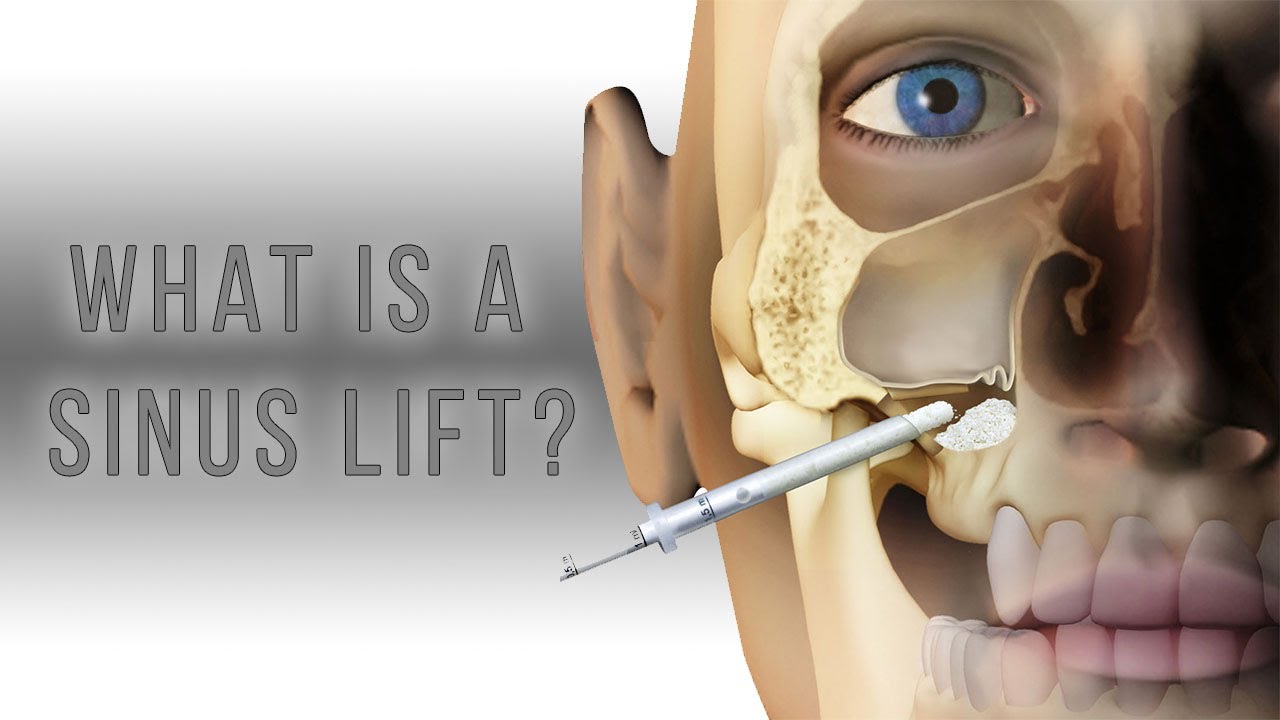 What is a sinus lift?