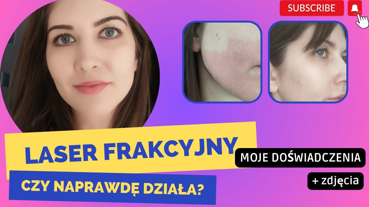 Laser frakcyjny to najlepszy zabieg na blizny. Moja historia.