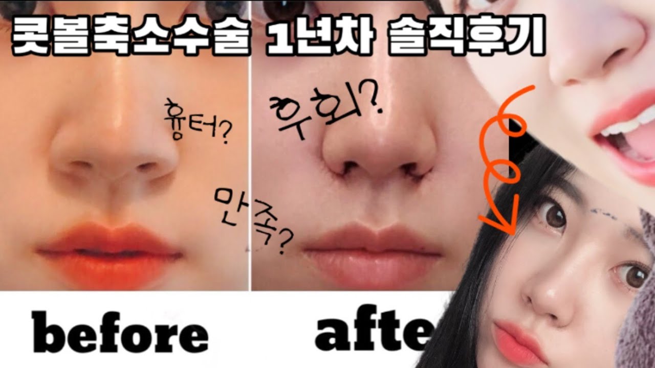 콧볼축소 1년차 후기 썰.👃🏻현재 흉터 자세히 보여드림 (내측+외측 반반 절개) 솔직후기ㅣ알라ALLA  BEAUTY