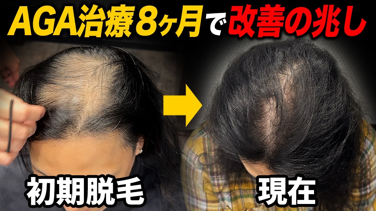 【改善の兆し!?】AGA治療薬を飲んで8ヶ月経過した本音