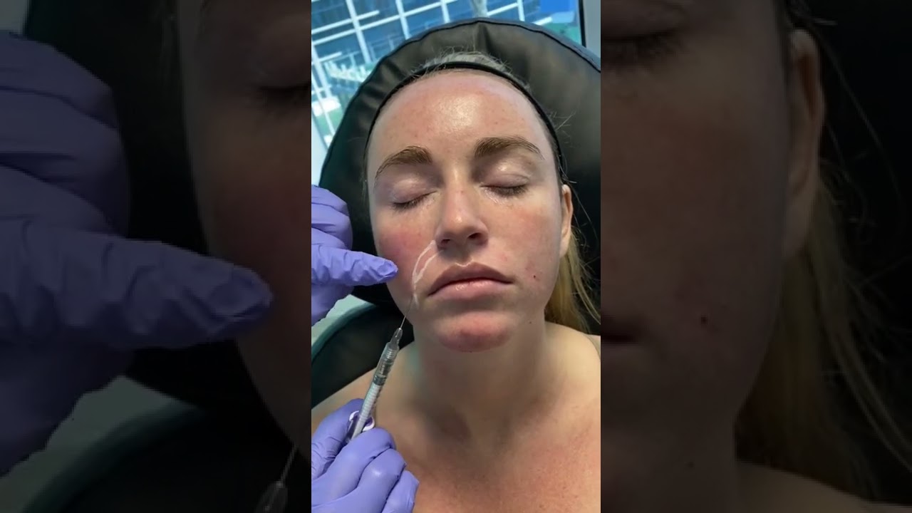 Smile Line Fillers Safely With Cannula