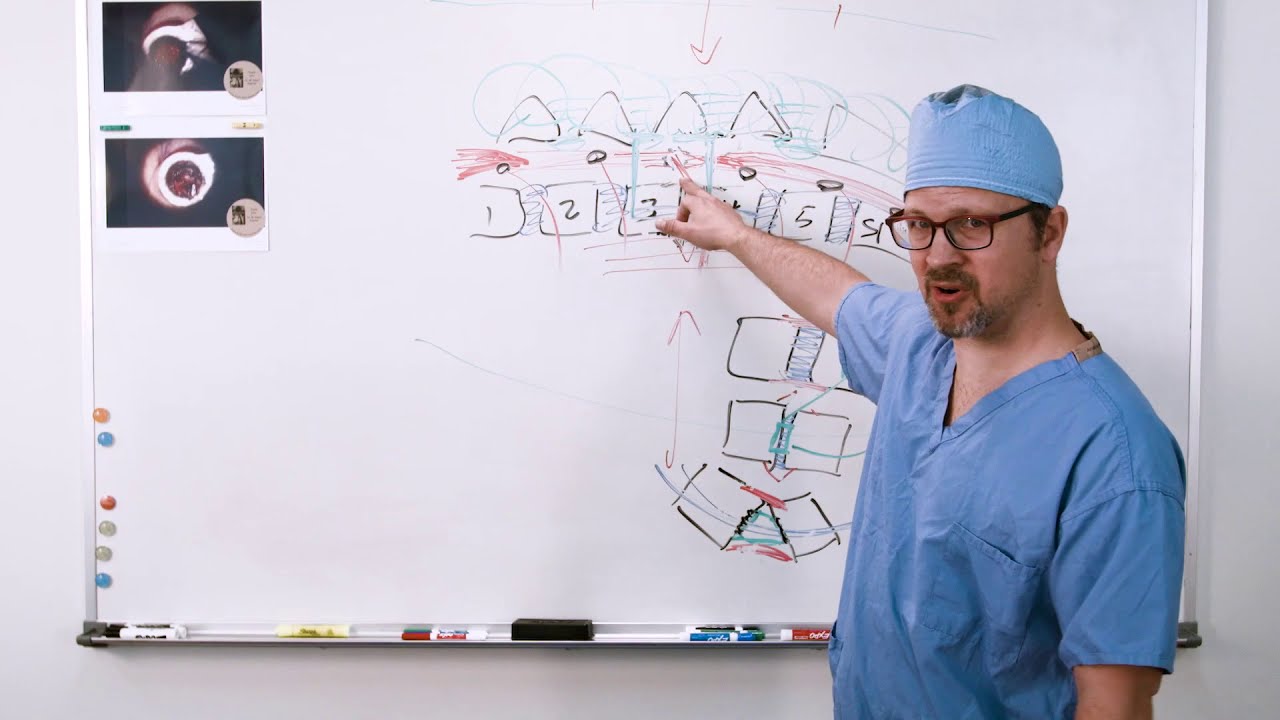 Pain Management | Post Operation | MIS-TLIF Transforaminal Lumbar Interbody Fusion