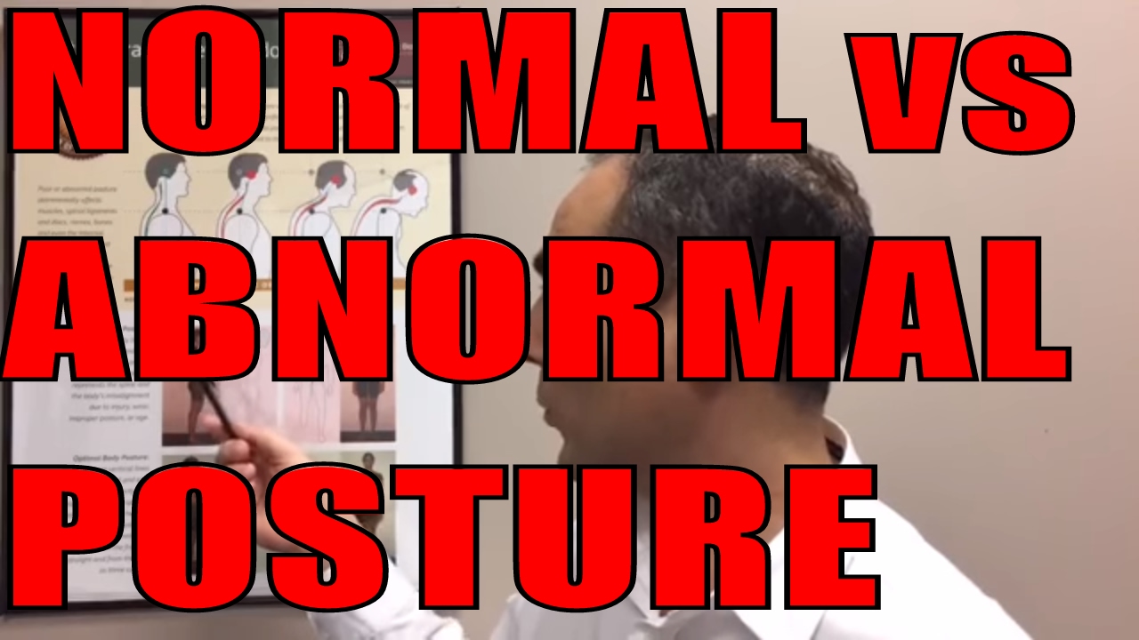 Ep 1 of 5 Posture Series. Normal Posture vs Abnormal Posture by Chiropractor in Vaughan