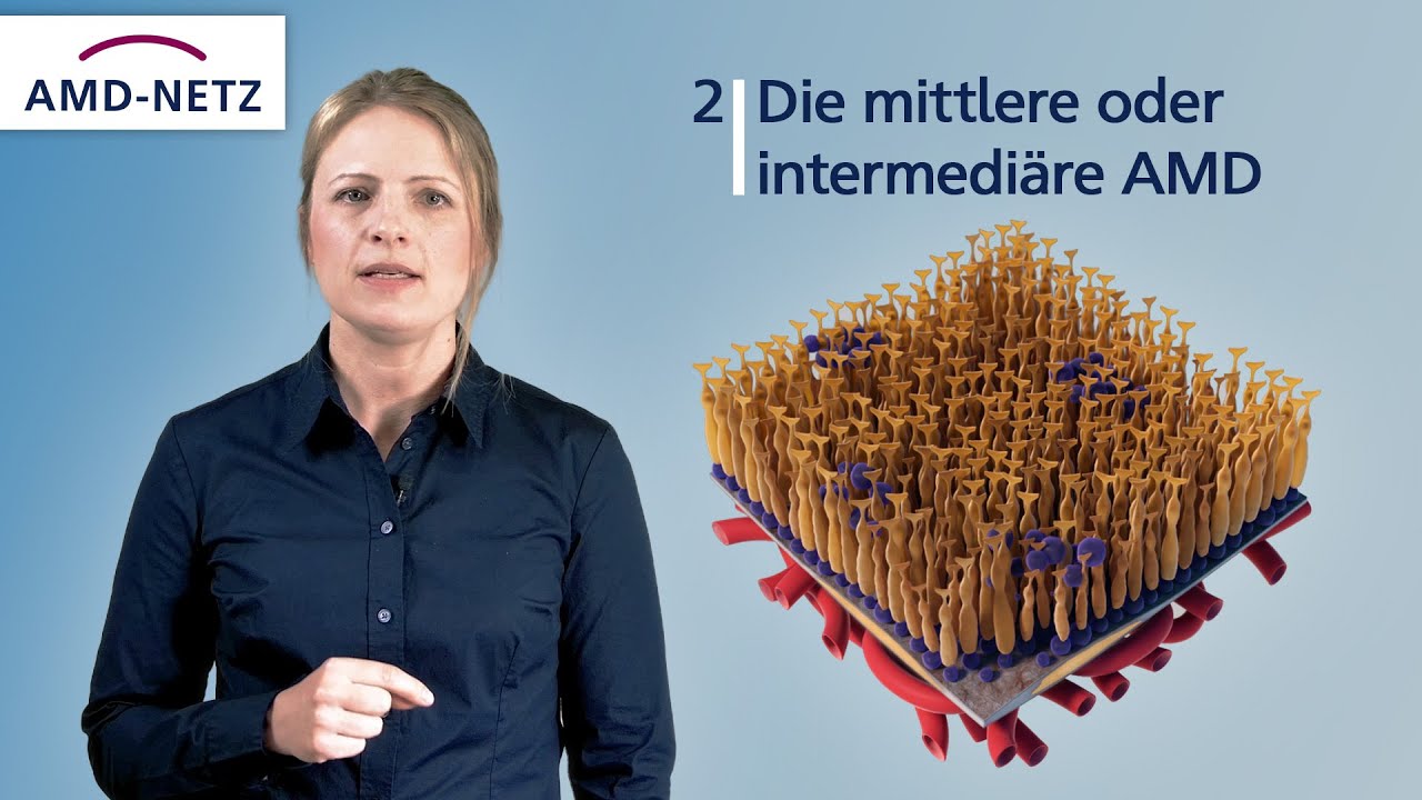 2. Die mittlere oder intermediäre AMD