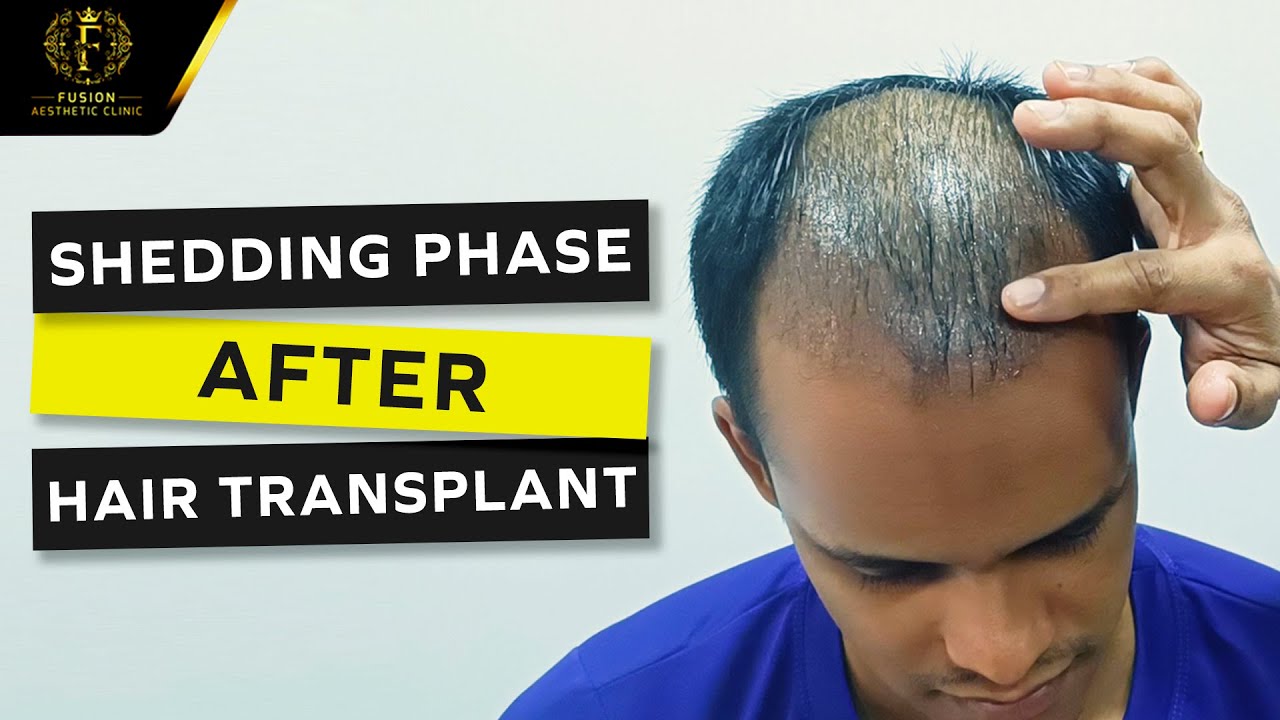 Shedding Phase After Hair Transplant | Explaining By Dr. Pranil More | Fusion Aesthetic Clinic