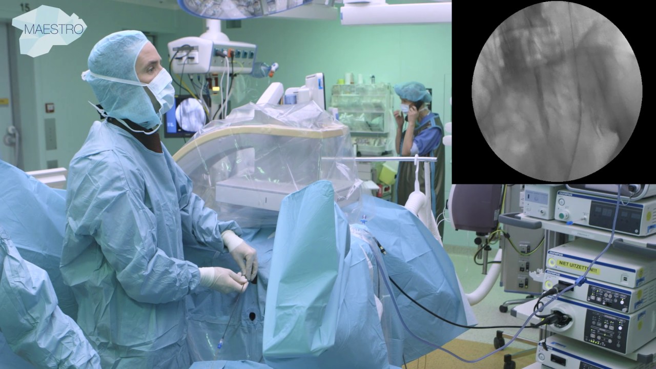 Placement of JJ stent