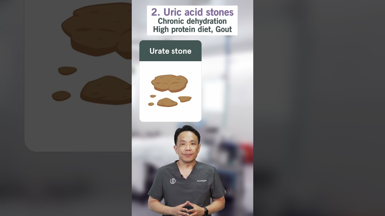 4 Types of Kidney Stones You Should Know