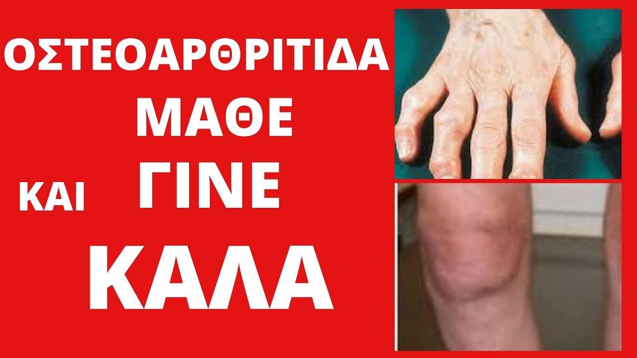 Φυσική Θεραπεία της ΟΣΤΕΟΑΡΘΡΙΤΙΔΑΣ   Δόκιμασμένος Σπιτικός Τρόπος για να ΝΙΚΗΣΕΤΕ την Ασθένεια.