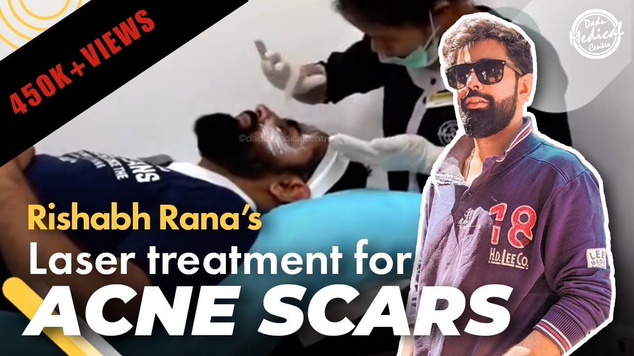 Advance Laser Treatments for Acne Scars | 