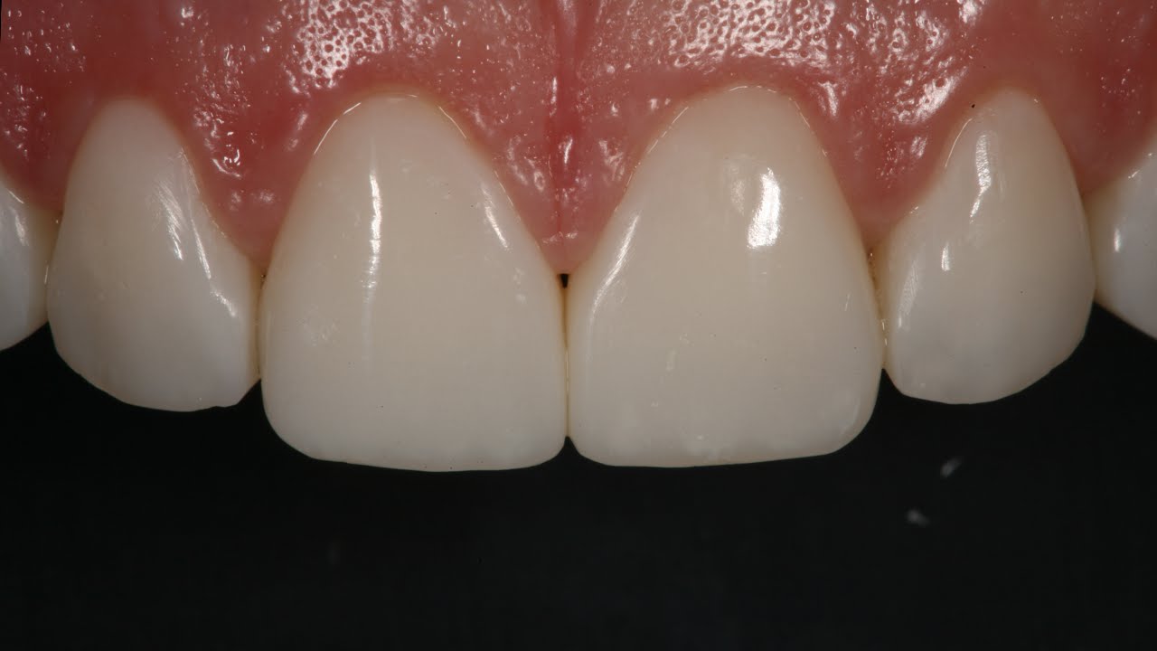 Resin Veneering and Freehand Diastema Closure