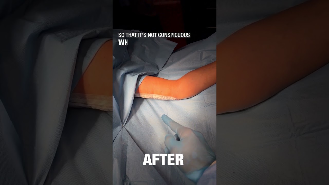 BEAUTIFUL result after an arm-lift with liposuction performed with local anesthesia and IV sedation!