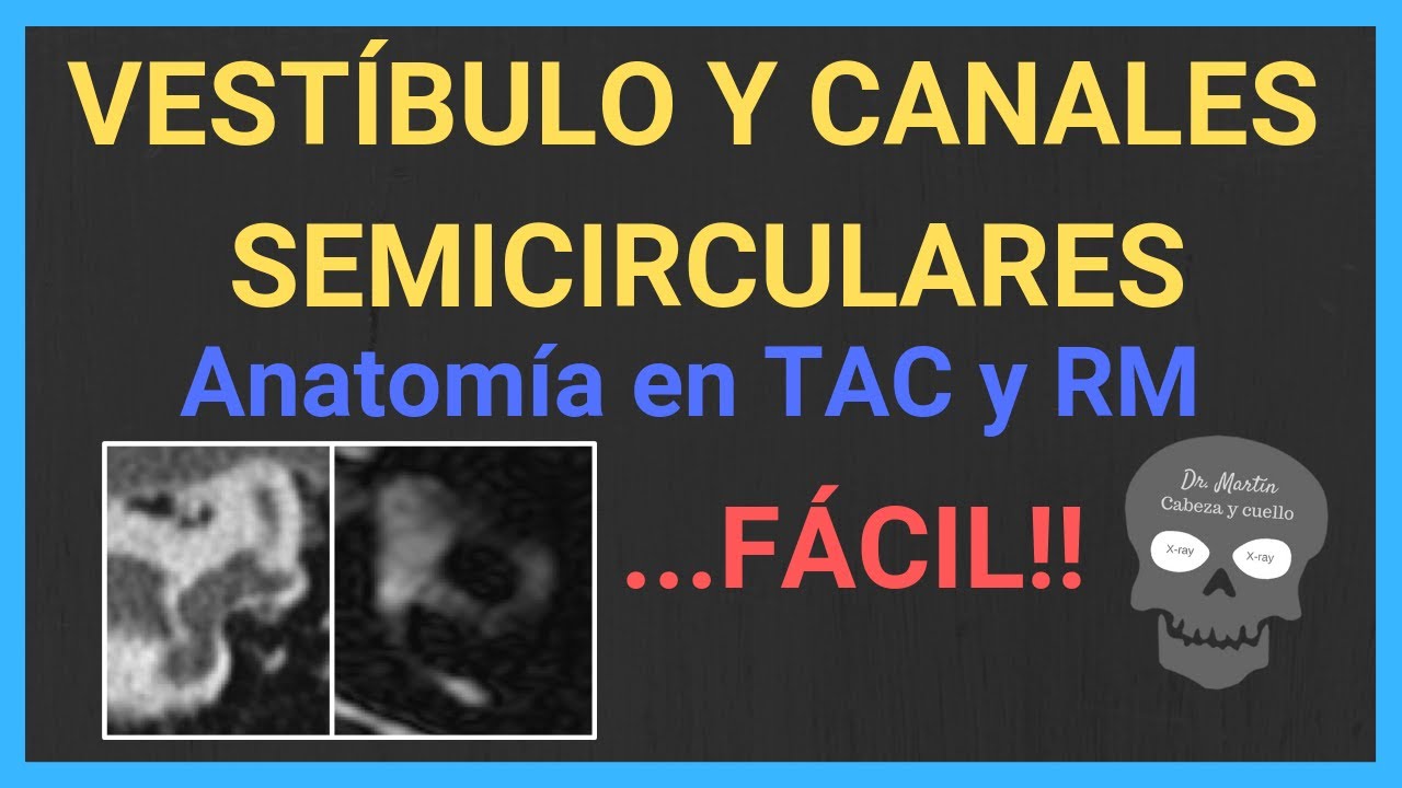 💀O&iacute;do interno 3: VEST&Iacute;BULO y CANALES SEMICIRCULARES [TAC/RM]