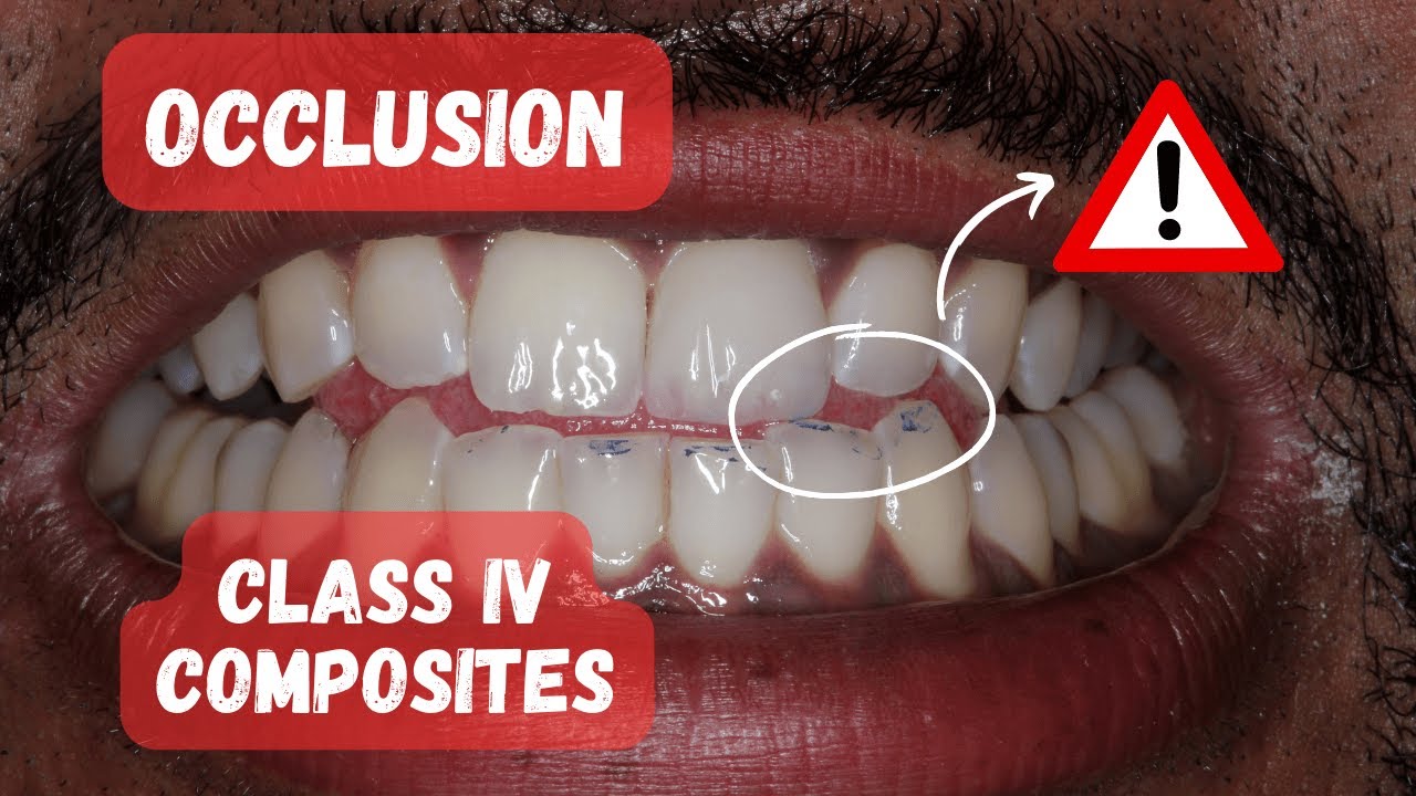 Occlusion on Class IV Composite Restorations - PDP150
