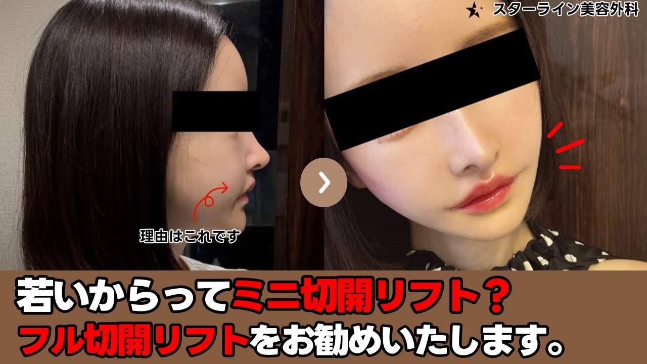 【切開リフト】若いからってミニ切開リフト？！ミニ切開リフトの真実