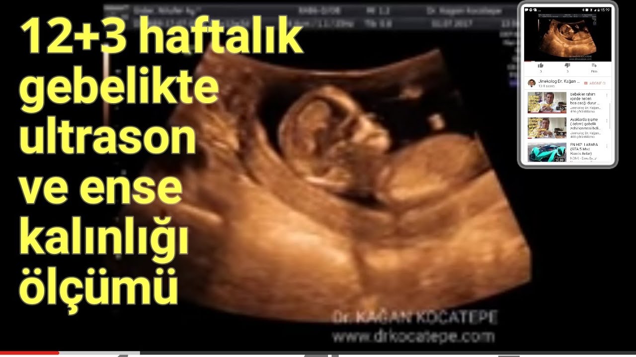 12. haftada bebekte ultrason ile organlar, burun kemiği, ense kalınlığı ve ikili test.