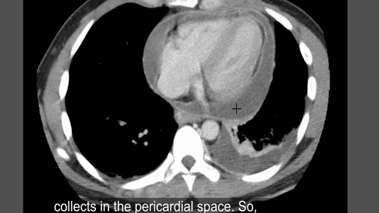 Chest x-ray interpretation, Pericardial effusion -  On different modalities