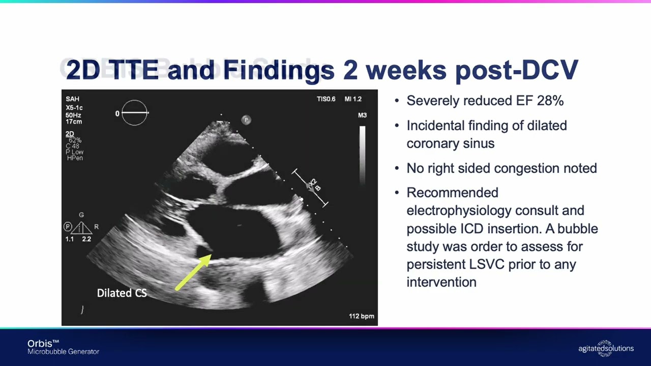 Persistent Left SVC Diagnosed by Cardiac Bubble Study | Orbis™ Microbubble Generator Case Study