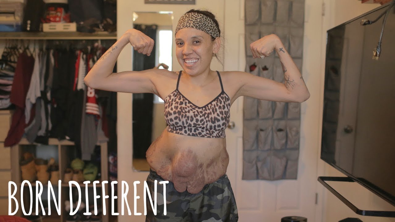 I&rsquo;m Finally Ready To Show The World My Tumours | BORN DIFFERENT