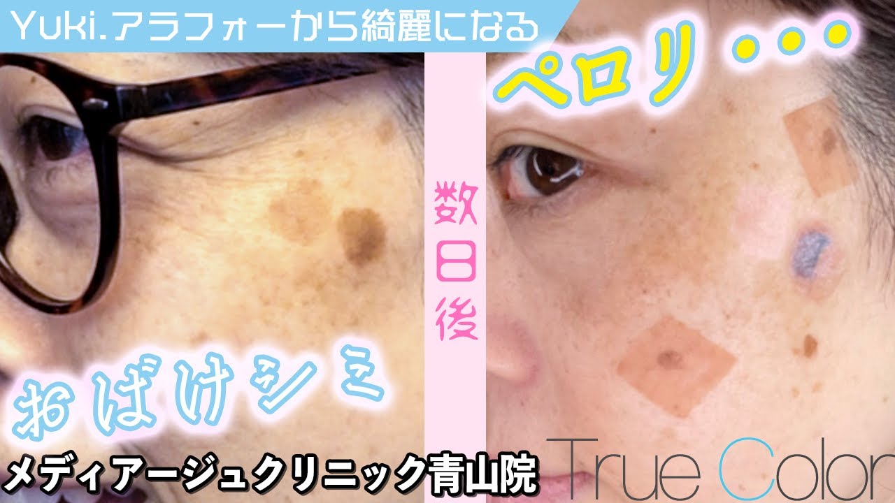 【シミとりレーザー治療】おばけシミ退治に挑む！ アラフォー美肌への道【Yuki.】