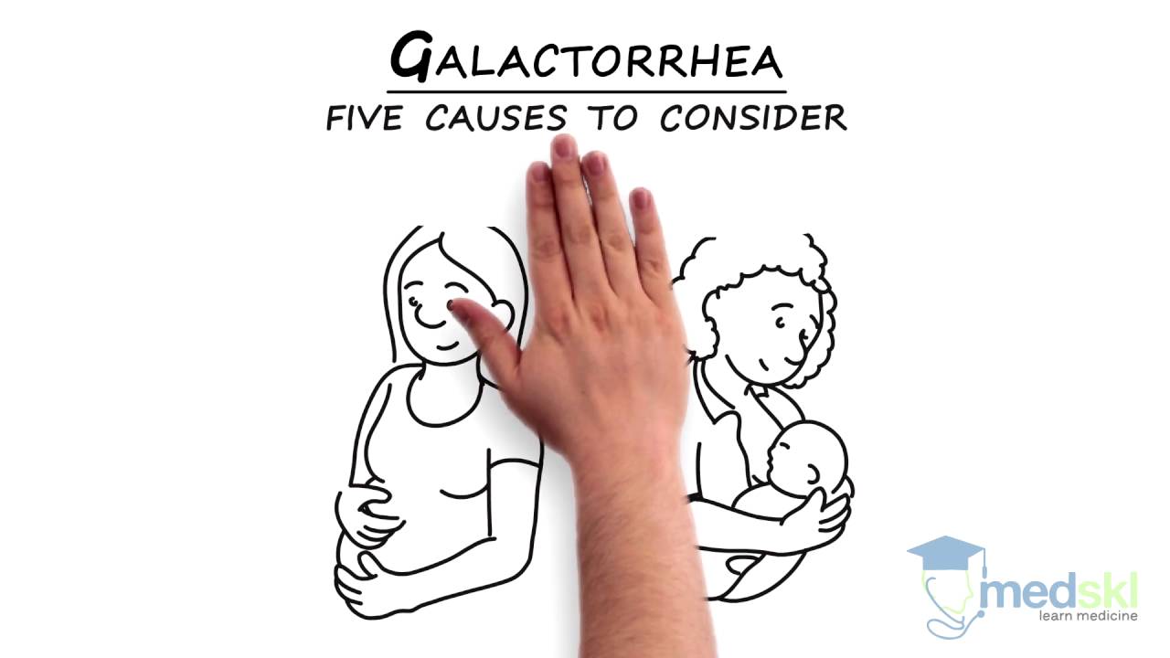 Endocrinology - Breast Discharge: By Jeannette Goguen M.D.