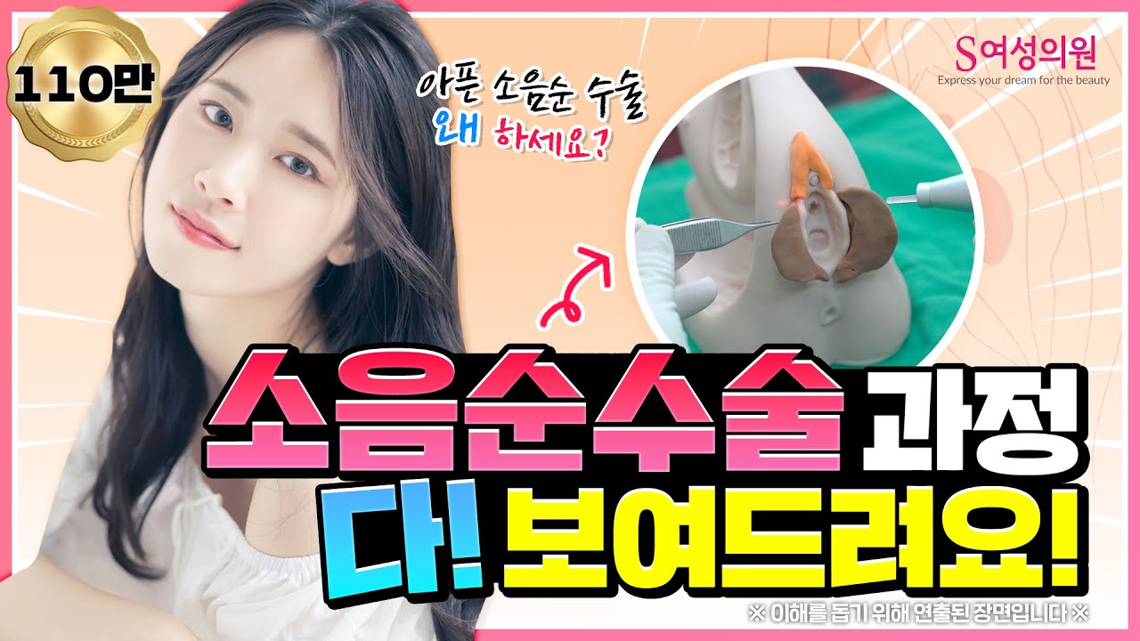 소음순수술 과정 다 보여드려요 ❗(소음순 성형시 필수영상/ 강남 산부인과)