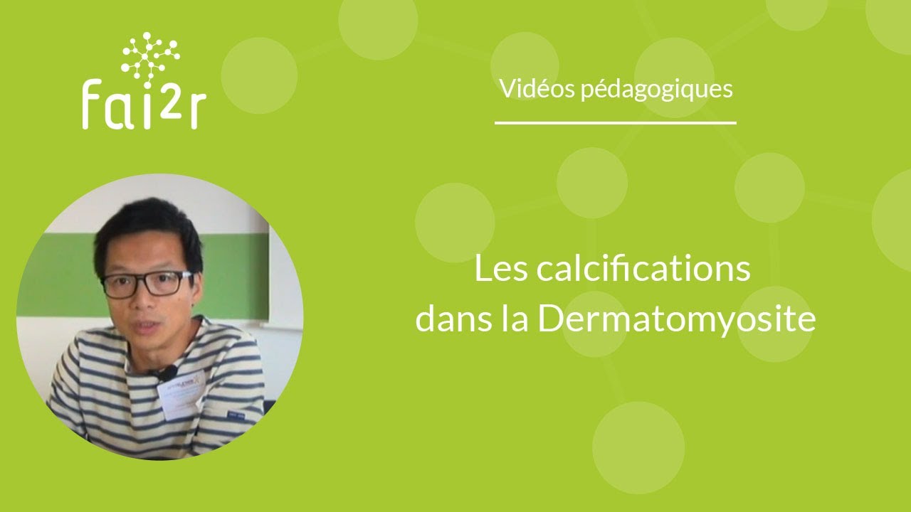 Les calcifications dans la dermatomyosite