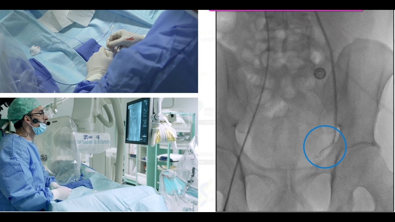 Le traitement des varicocèles par embolisation