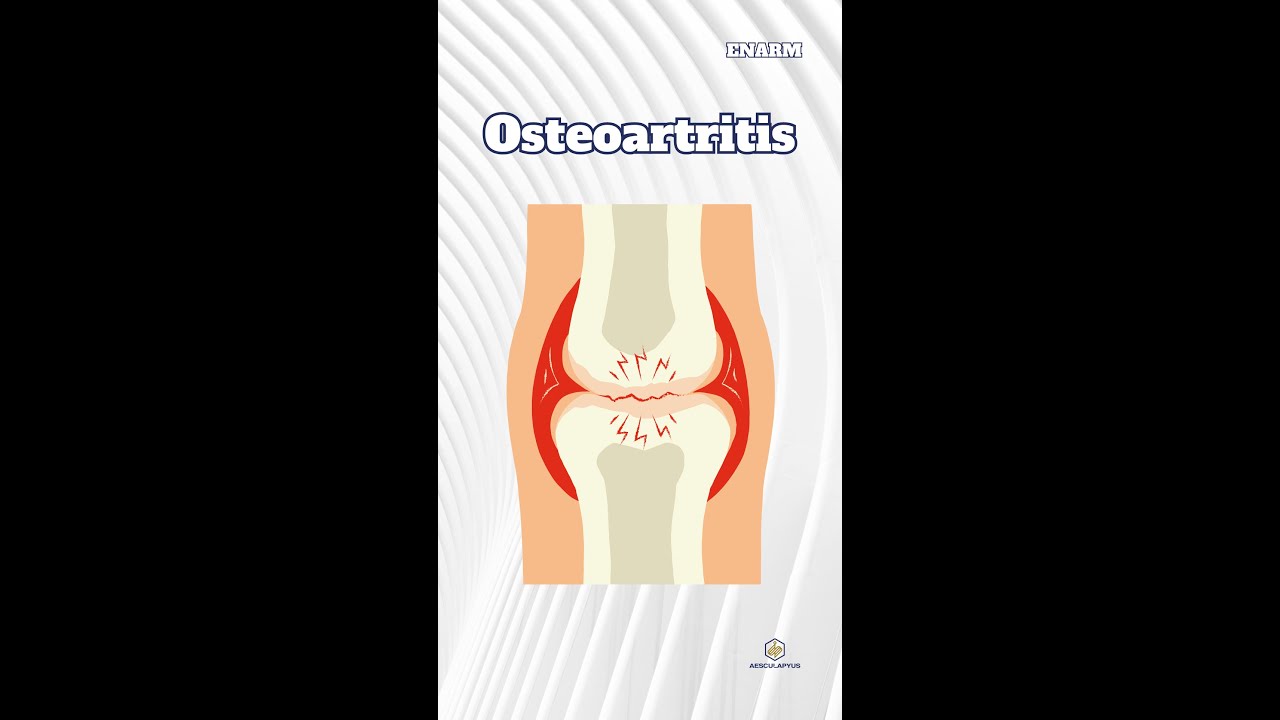 Osteoartritis