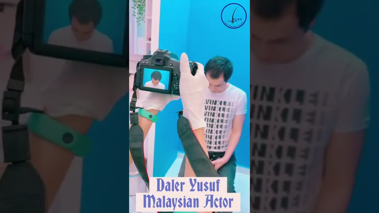 DALER YUSUF (MALAYSIAN ACTOR) DID HIS PRP AFTER HAIR TRANSPLANT