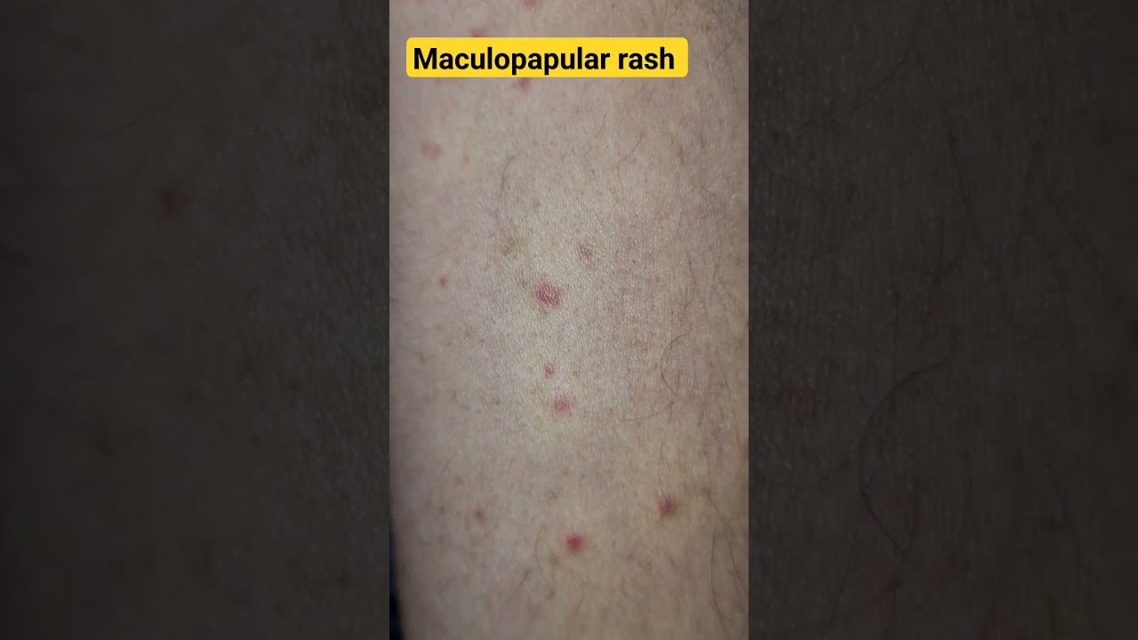 maculopapular rash