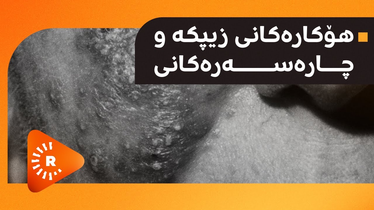 هۆکارەکانی زیپکە و چارەسەرەکانی!!